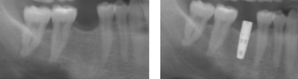 Controle radiographique - Implant dentaire Toulouse