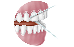 Brossage des dents et des gencives - Dentiste Toulouse