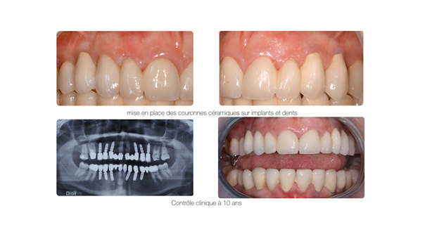 Implant dentaire et couronne dentaire Toulouse