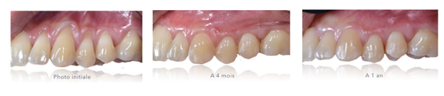 Parodontologie dentaire Toulouse