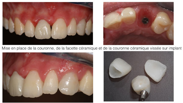 Implant dentaire Toulouse - Dentiste Toulouse