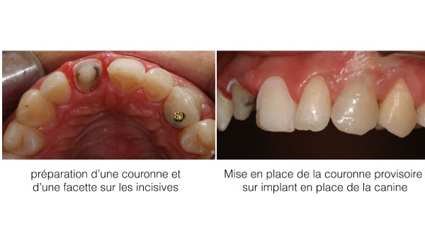 Implant dentaire Toulouse - Dentiste Toulouse